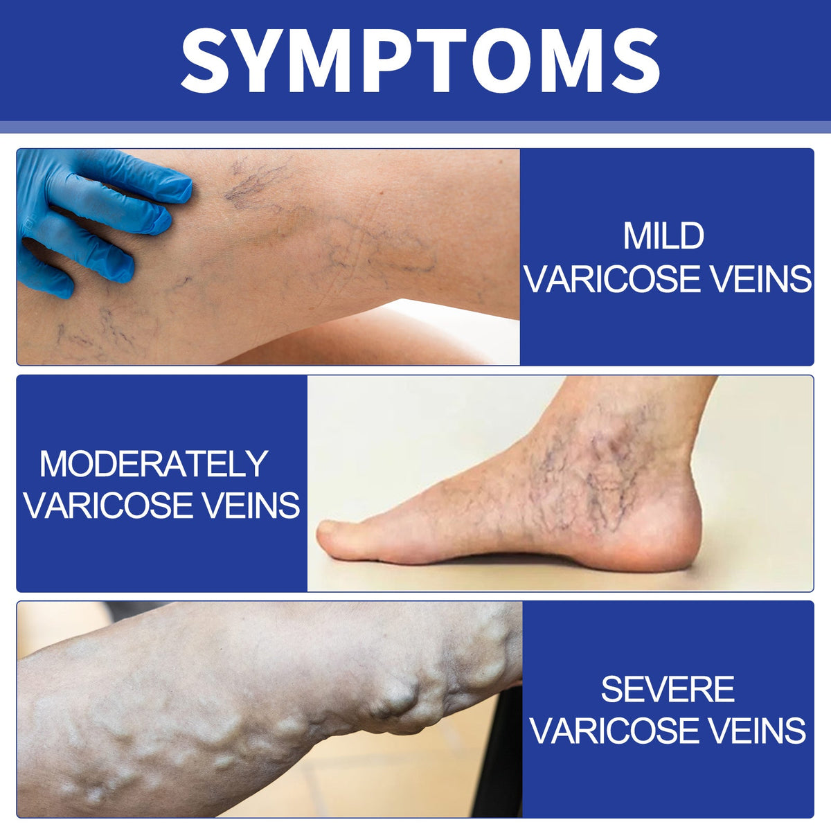 Vein Comfort Spray, Relief Leg Muscle Soreness And Swelling Earthworm Leg Vein Treatment Spray